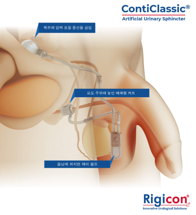 ContiClassic<sup>®</sup> Artificial Urinary Sphincter Product Illustration