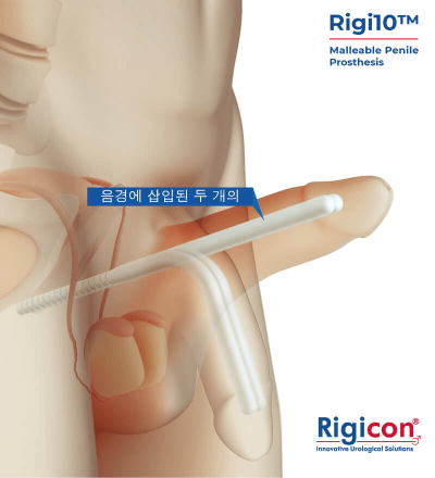 Rigi10&trade; Malleable Penile Prosthesis Product Illustration